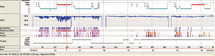 /fd/psg/hypnogram.gif